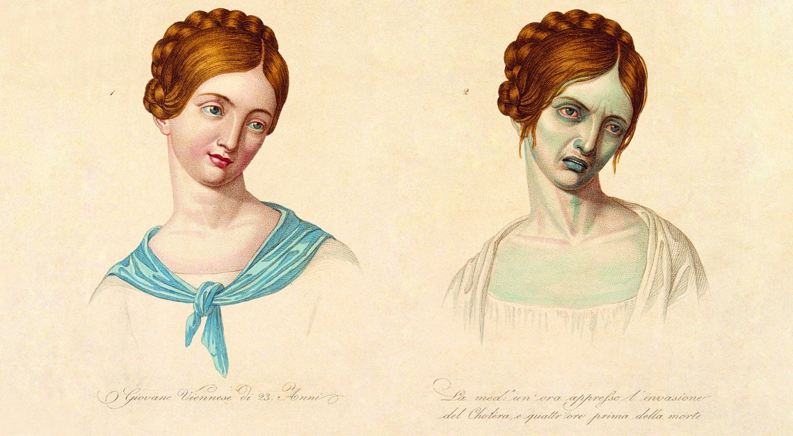 Woman, aged 23, depicted before and after contracting cholera. Coloured stipple engraving. (via)
