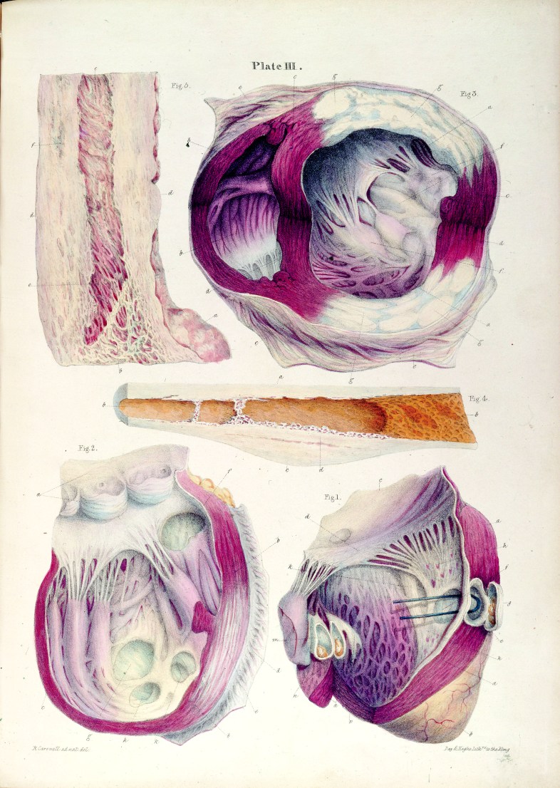 The development of open-heart surgery in the twentieth century depended on, among many other things, a fine- level knowledge of the structure and function of the living heart, as embodied in these illustrations from Robert Carswell’s Pathological Anatomy, published in 1838. via