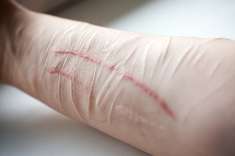 I'm Popular, Funny, Confident…And I Self-Harm | Thought Catalog