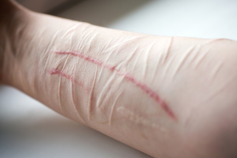 I'm Popular, Funny, Confident…And I Self-Harm | Thought Catalog I'm Popular, Funny, Confident…And I Self-Harm | Thought Catalog