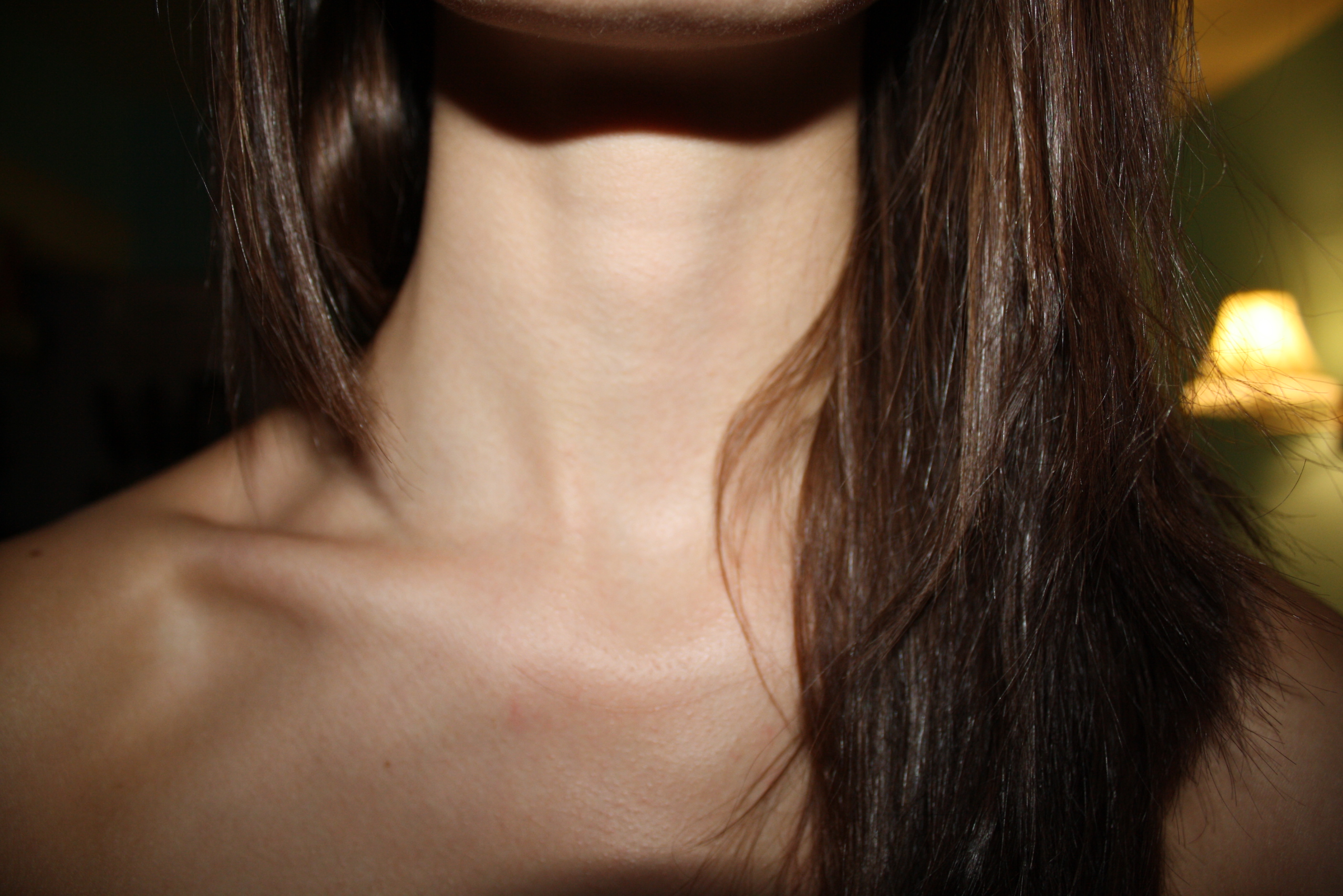 Is That Hickey A Dangerous Blood Clot?  Symptoms You Need To Know - 7pj3obm