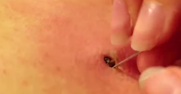 Watch The Insane Removal Of This 25-Year-Old Blackhead