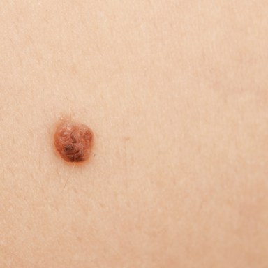 The Problem With “It’s ONLY Skin Cancer, Right?”