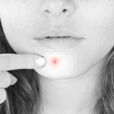 10 Little-Known Perks Of Having Acne