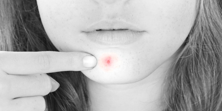 10 Little-Known Perks Of Having Acne