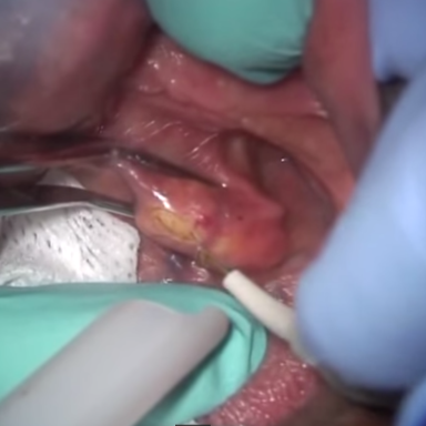 Watch These Dentists Remove A Huge Salivary Stone Under A Patient’s Tongue