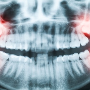 5 Things I Learned When I Had My Wisdom Teeth Removed