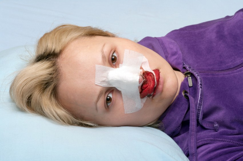 7 Secrets You Need To Know About Recovering From A Nose Job