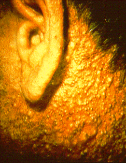 Chloracne in this herbicide production worker involved almost every follicular orifice on his face and neck with comedones, papules and cystlike lesions. Source: Wikimedia