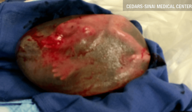 “We All Caught Our Breath” Doctor Describes Unlikely Delivery Of A Baby Born Still Inside Its Amniotic Sac