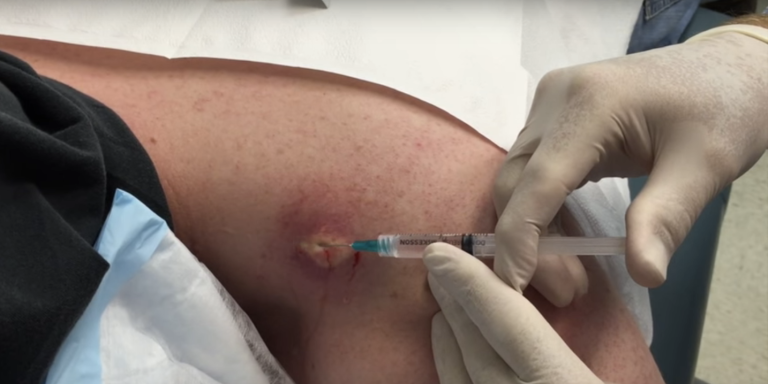 Watching This Infected Cyst Get Drained Is Weirdly Satisfying