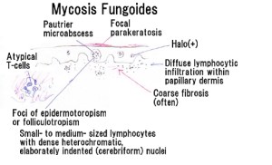 Mycosis_fungoides_stp5