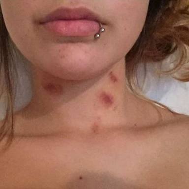 40 Insane Photos Of Hickeys That Will Make You Think Twice About Sucking Face