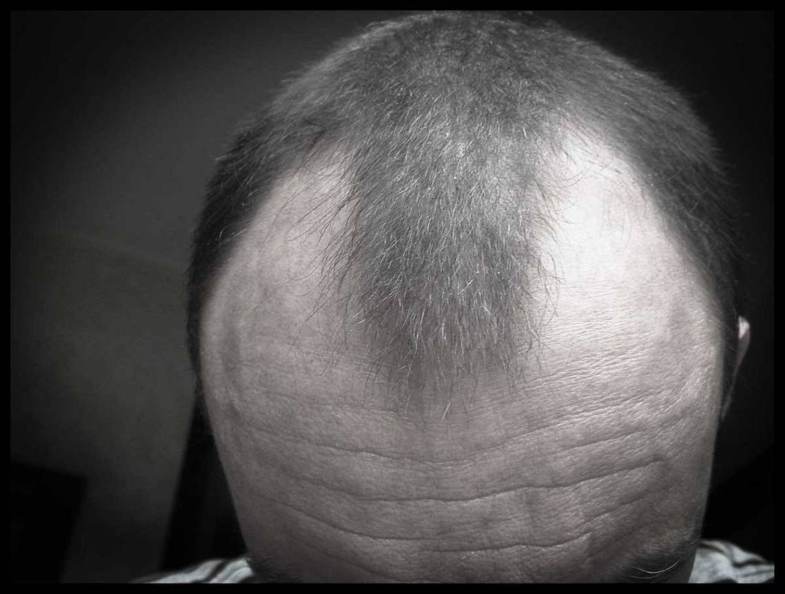 Balding Man