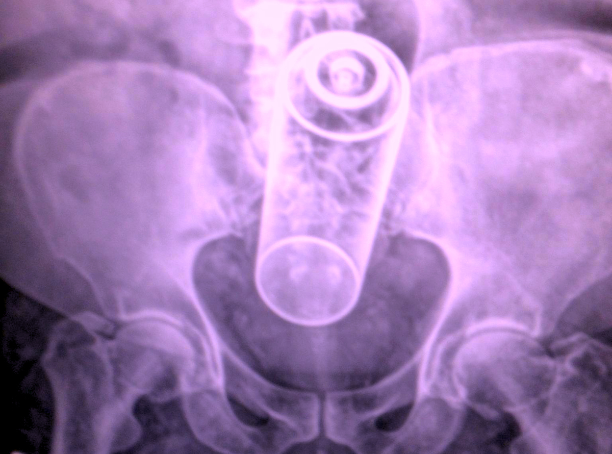 I Fell On It, Doc, I Swear! 27 Hilarious Stories Of Rectal Foreign Objects That Became Medical Emergencies Thought Catalog picture