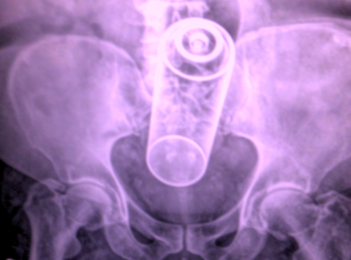 I Fell On It, Doc, I Swear! 27 Hilarious Stories Of Rectal Foreign Objects That Became Medical Emergencies Thought Catalog