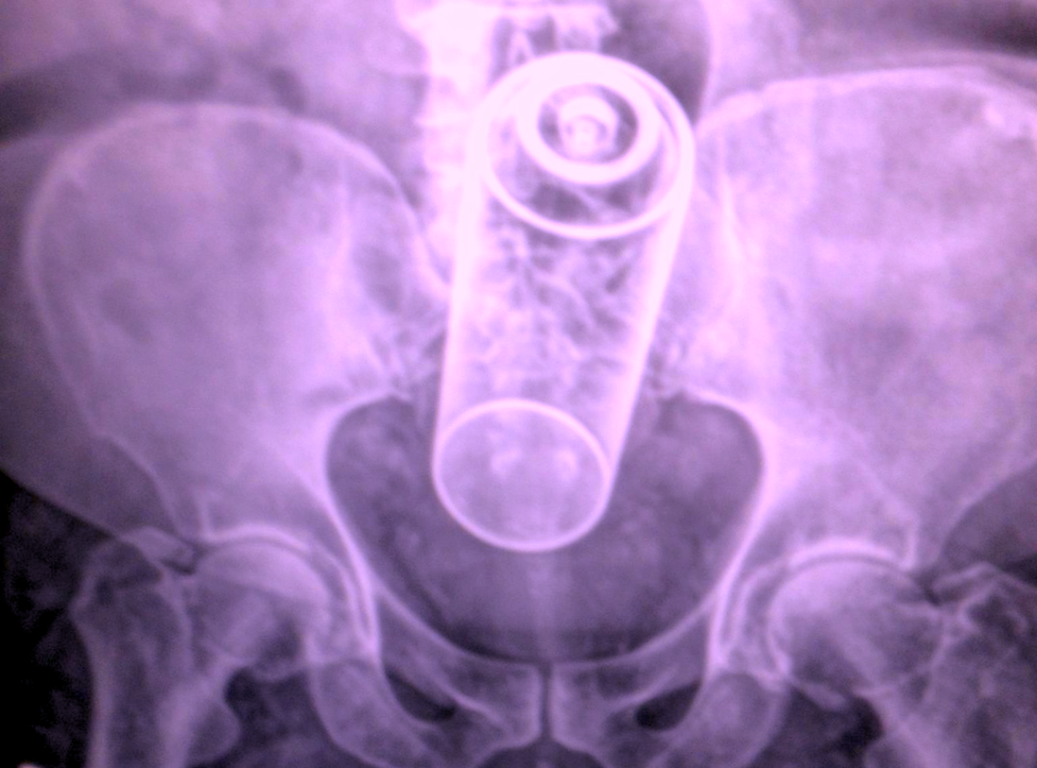‘I Fell On It, Doc, I Swear!’: 27 Hilarious Stories Of Rectal Foreign Objects That Became Medical Emergencies