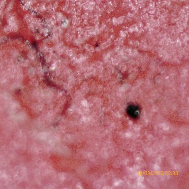Morgellons Disease: Is It Real, Or Just Really Crazy?
