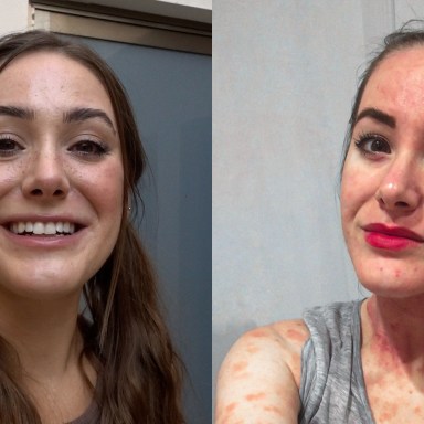 Finding Beauty In The Struggle With Eczema Advocate, Sabina Trojanova