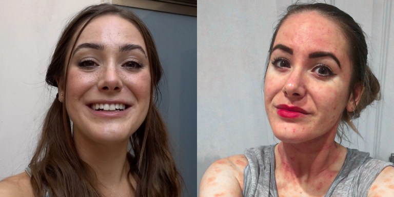 Finding Beauty In The Struggle With Eczema Advocate, Sabina Trojanova